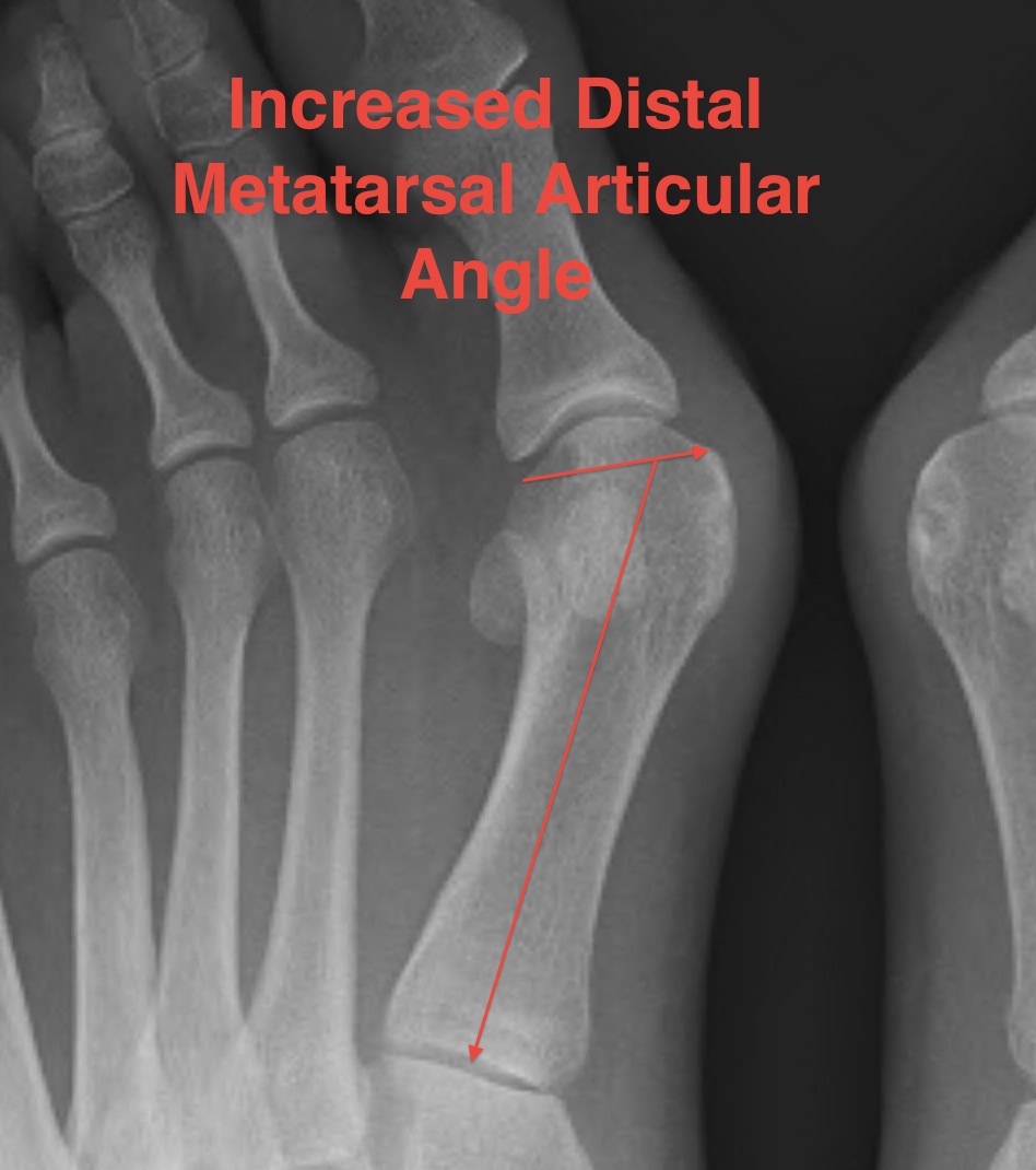 Hallux Valgus Increased DMAA